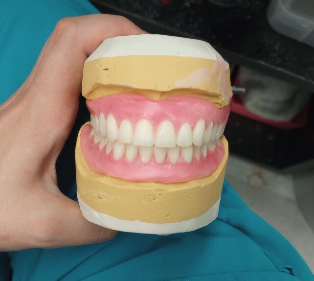 photo of a mock up of a denture. Individual teeth are place in wax, which is shaped over stone models of the patients gums